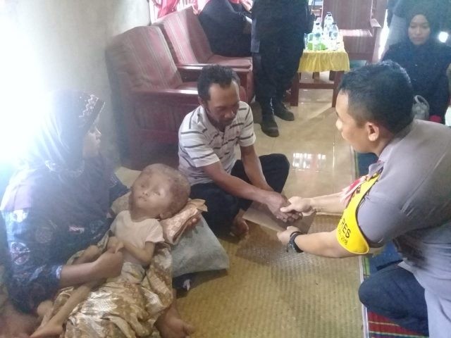 Polres Binjai Santuni Keluarga Penderita Penyakit Hydrocepallus