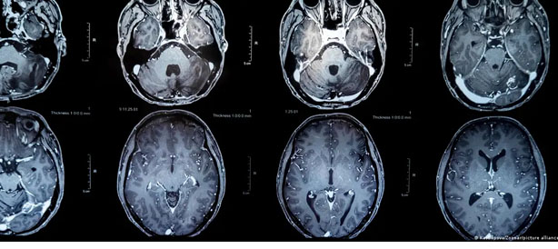 Kabar Gembira Vaksin Tumor Otak Tunjukkan Hasil yang Besar